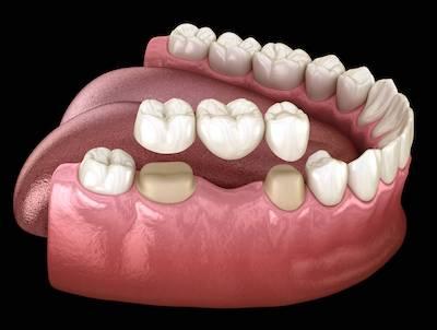 Model of a dental bridge in Booragoon Dentist