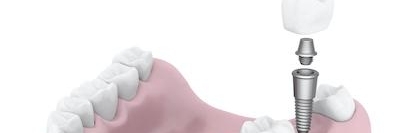 dental implant illustration in booragoon wa