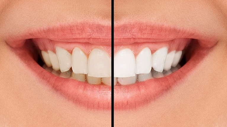 Teeth whitening picture | Booragoon WA