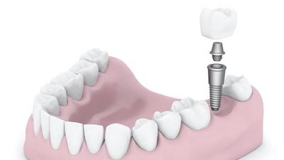 Dental implant diagram booragoon