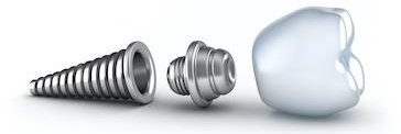 illustration of dental implant in booragoon