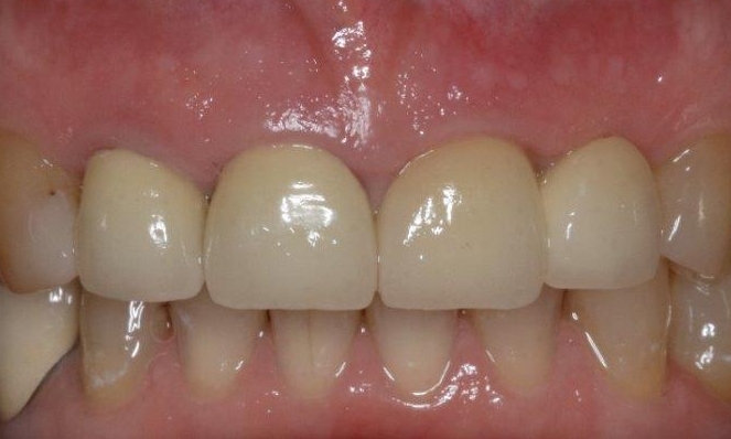 Implant & Crown | Booragoon Dentist