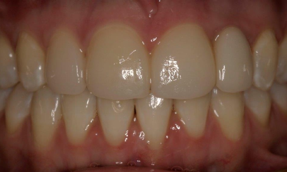 Veneer After Photo | Booragoon Dentist