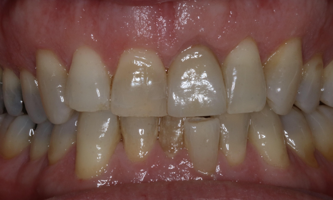 patient with new dental implant crown booragoon