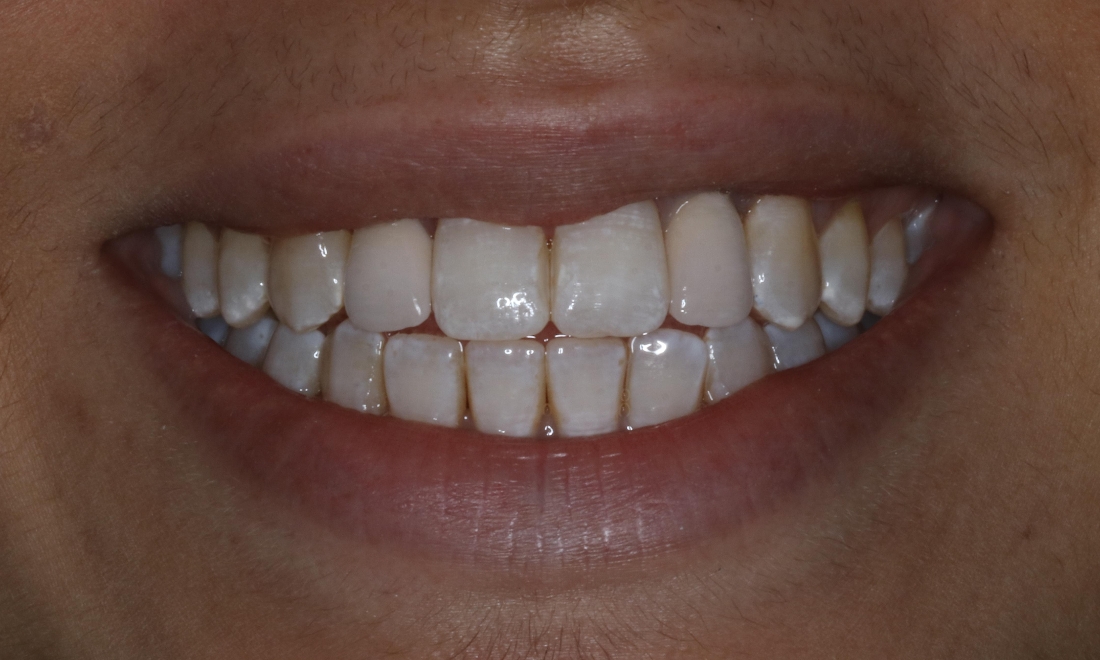 patient after dental implants booragoon