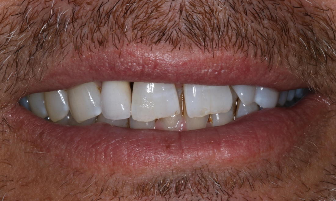patient with new dental crown