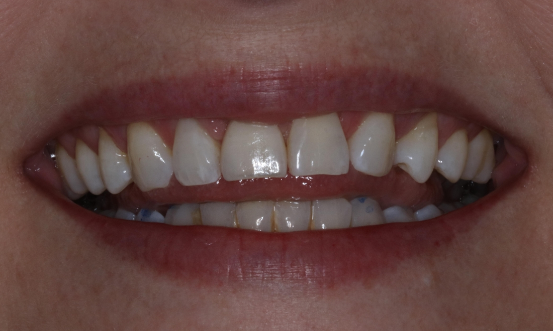 Dental Implant & Crown After Photo