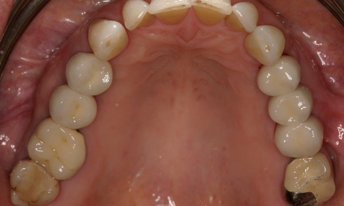 Dental Implant Pic | Booragoon Western Australia