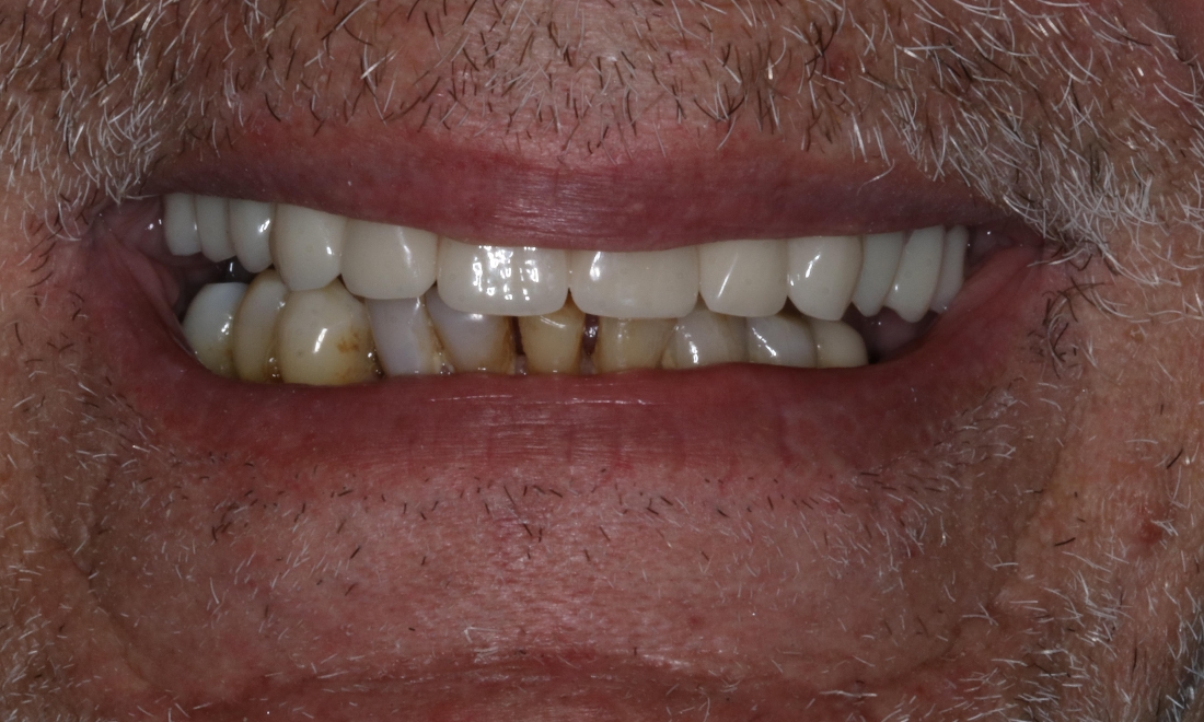 dental bridges in booragoon 
