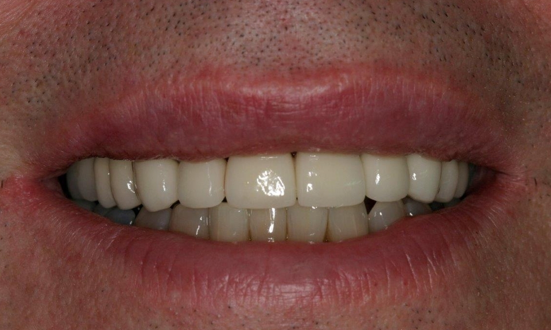 Patient with dental crowns | Booragoon WA
