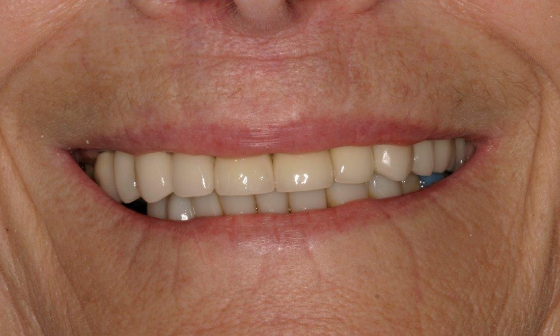 Patient After crowns and bridges | Mount Pleasant Dentist