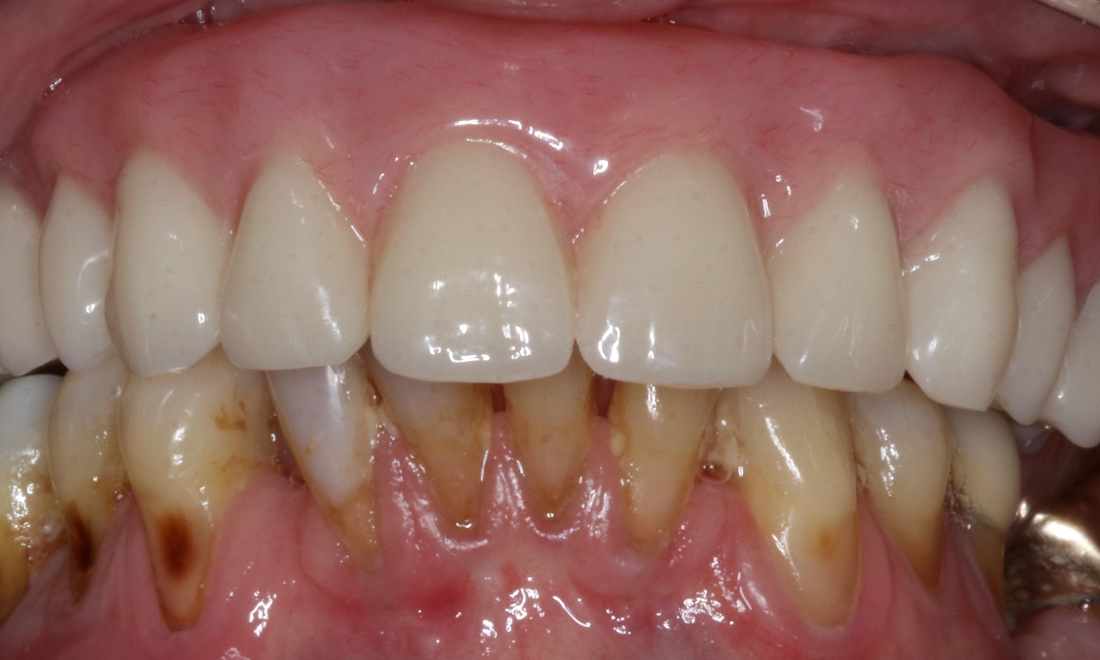 patient with new dental implant in booragoon