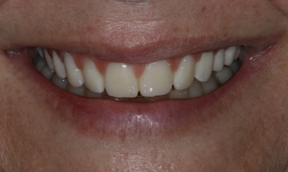Dental Implants After Photo Booragoon