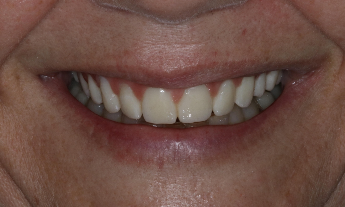 Patient after dental bridge placed in Booragoon