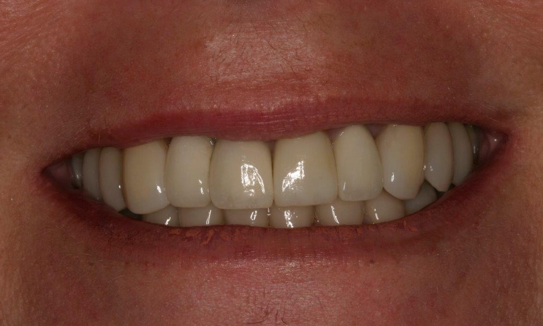 Dental Implants in Alfred Cove | Booragoon WA