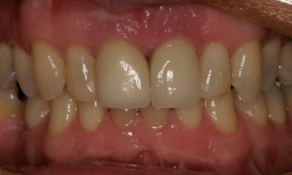New Dental Implant | Booragoon Dentist