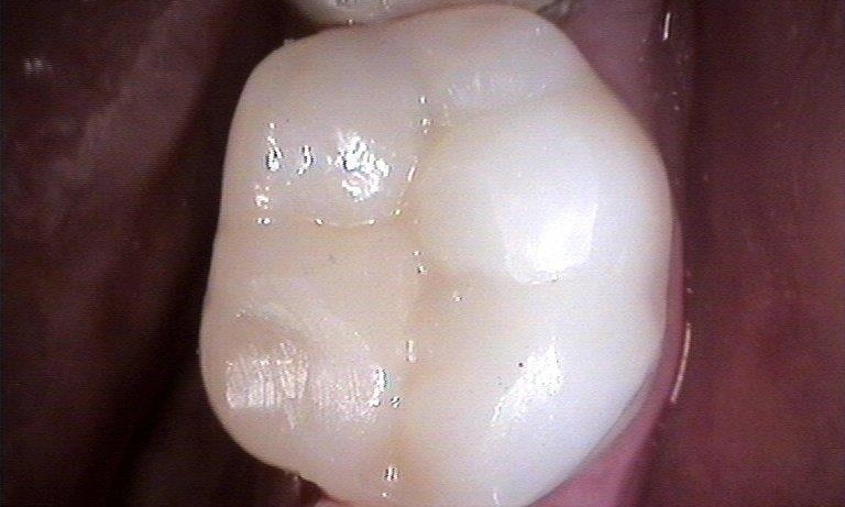 Tooth Colored Filling | Booragoon WA Dentist