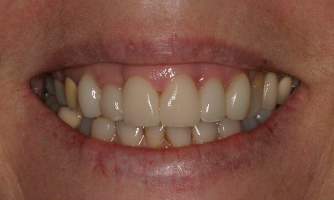 Dental Veneers | Booragoon Cosmetic Dentist
