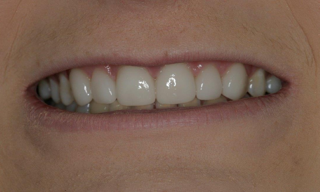 New Veneers photo | Booragoon Dentist