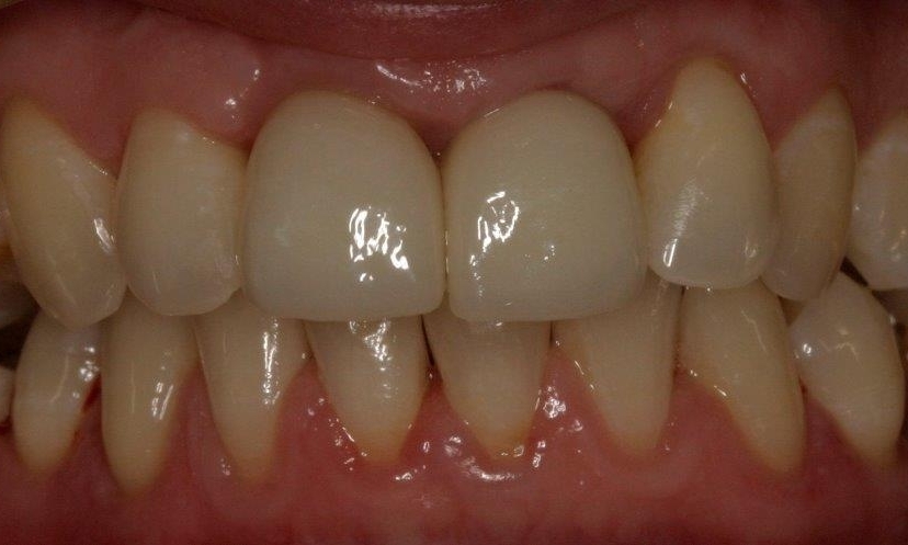 Dental Crown | Booragoon Dental Implants