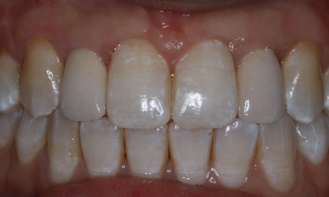 Patient with new dental implants in Booragoon