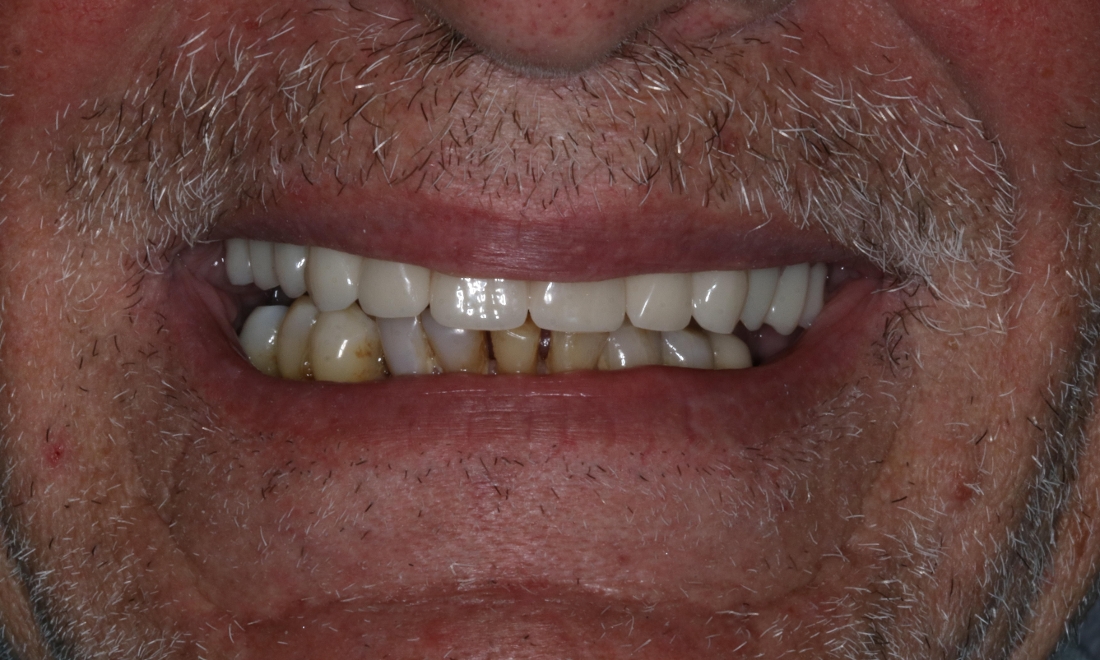 man after new dental implant placement