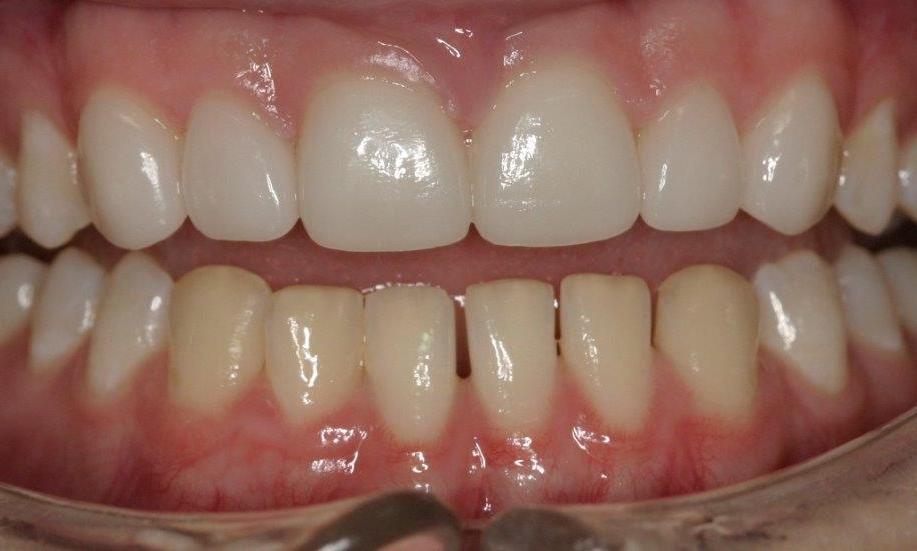 Patient with Veneers | Booragoon Dentist