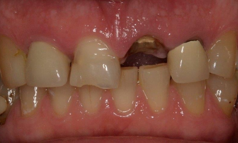 Missing Tooth in Booragoon | Dental Implants