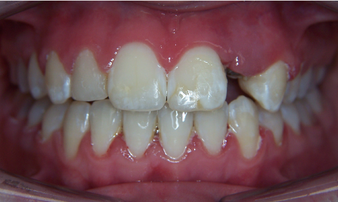 Patient Before Veneers | Booragoon Dentist