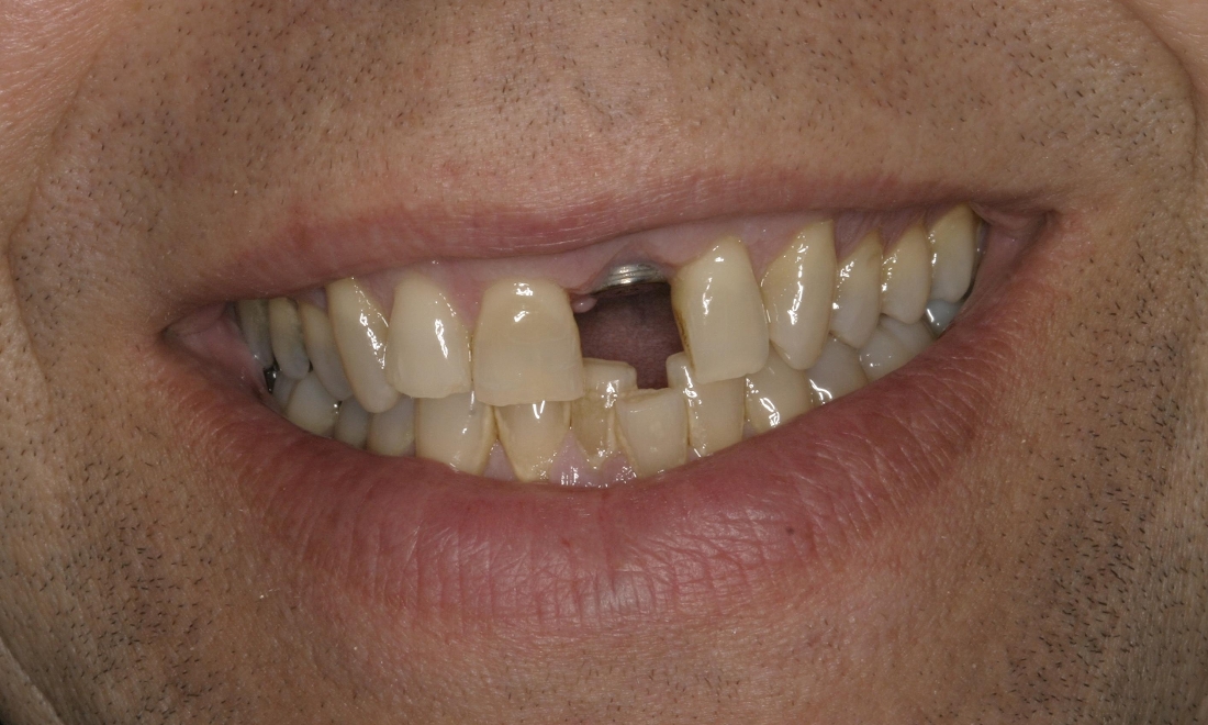 Patient before a new implant and crown 