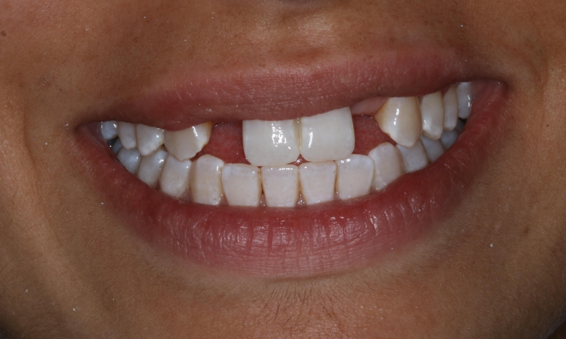 Patient before dental implants booragoon