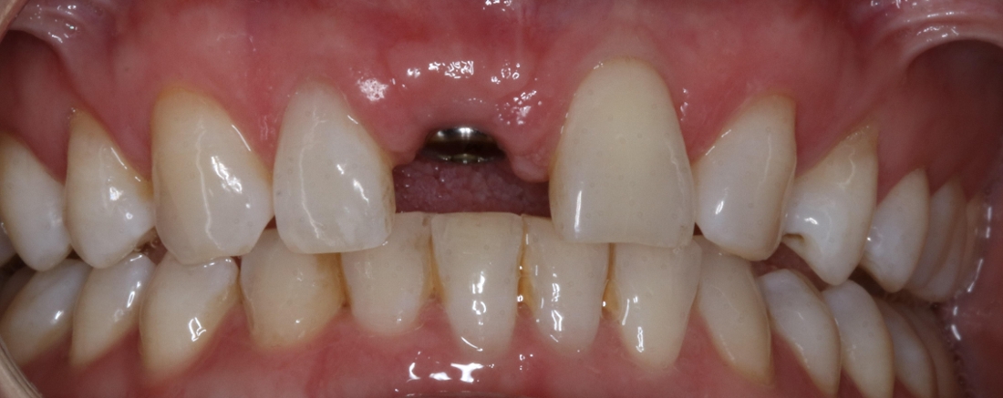 Dental Implant Crown Before Photo