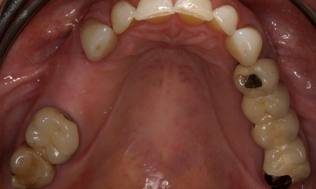 Missing Tooth | Booragoon Implants