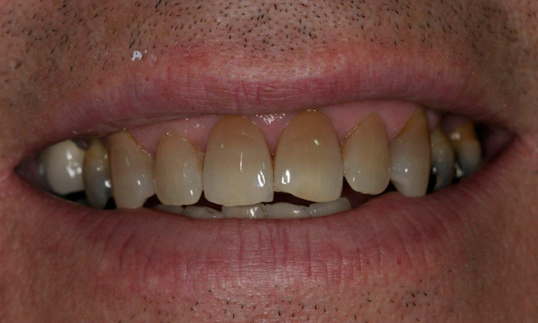 Patient before dental crowns | Booragoon WA