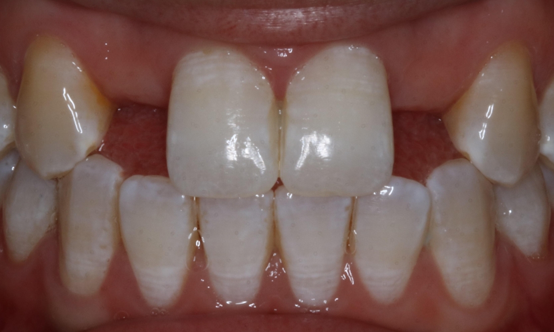 Patient in need of dental implant in Booragoon