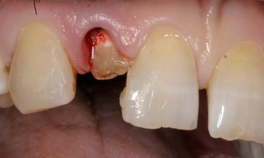 patient before dental implant in booragoon