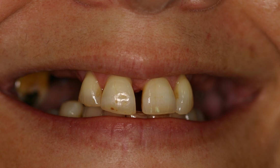 Dental Implants Before | Booragoon