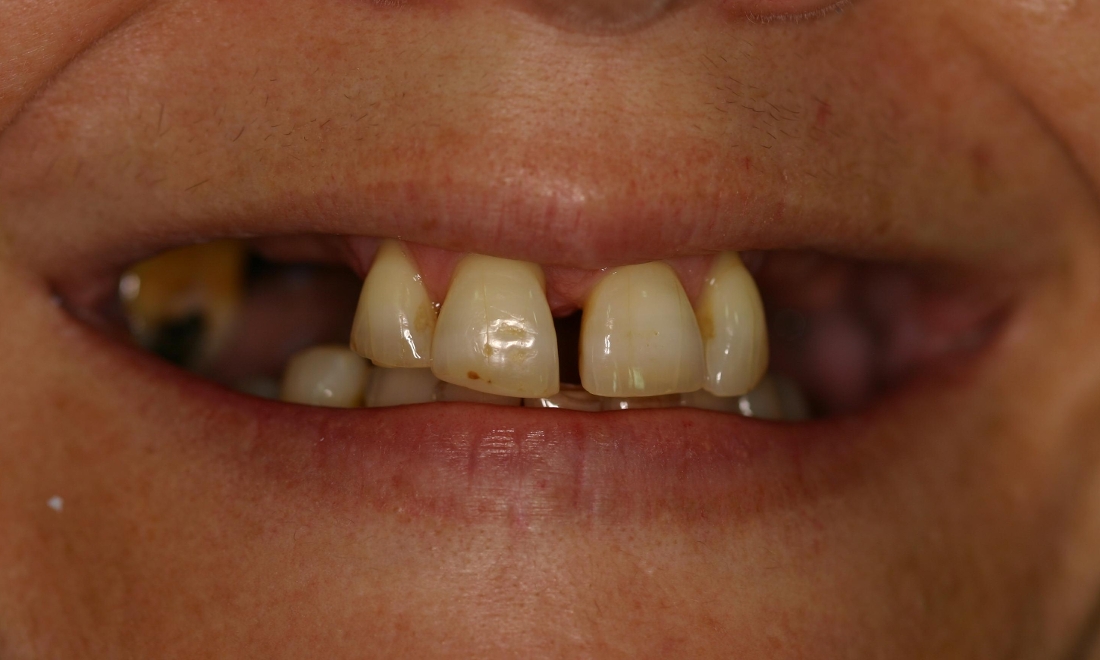patient before dental bridge in Booragoon