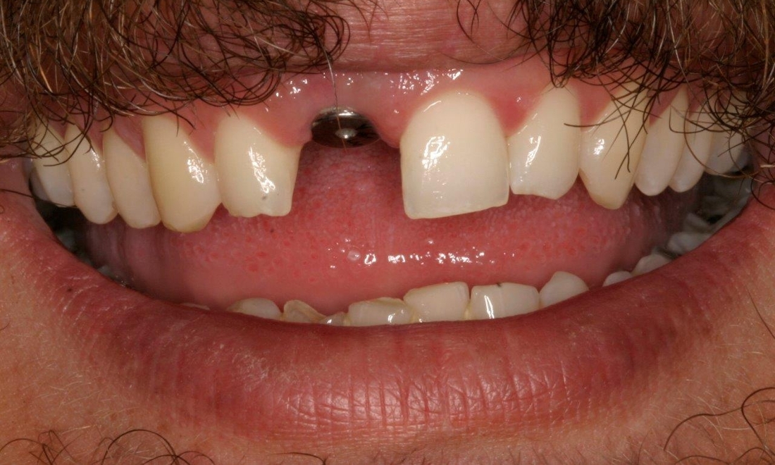 Missing Tooth | Dental Implants Booragoon