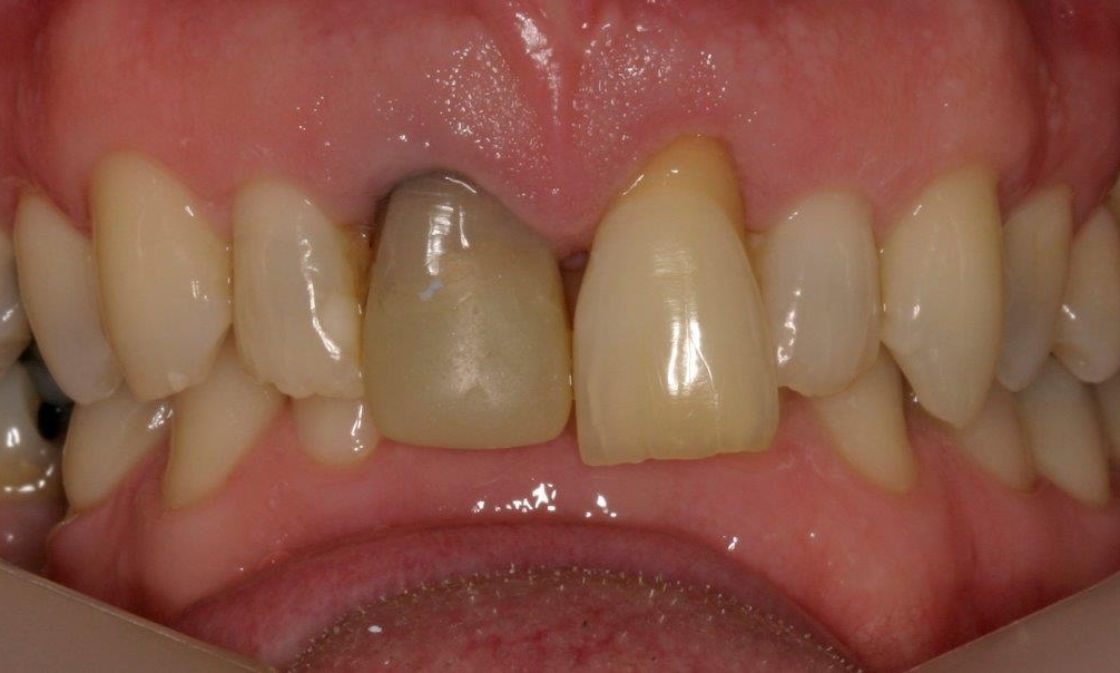 Patient before new implant | Booragoon Dentist