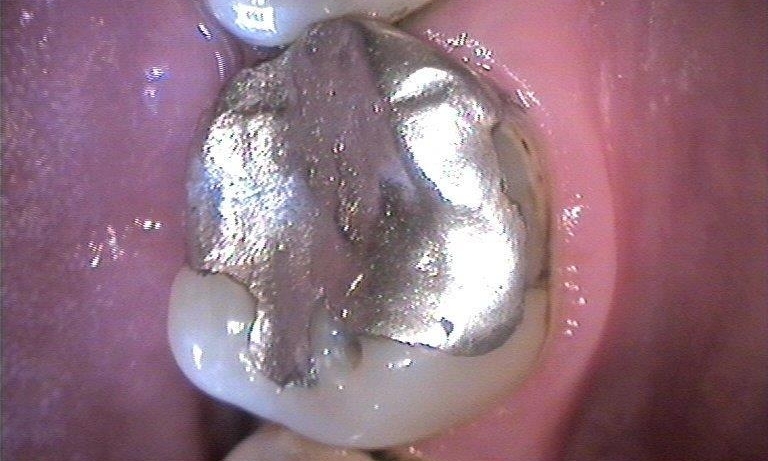 Silver Filling | Booragoon WA Dentist
