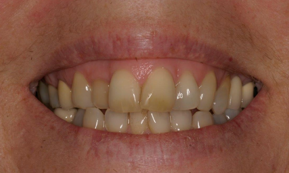 Porcelain Veneers | Booragoon Dentist