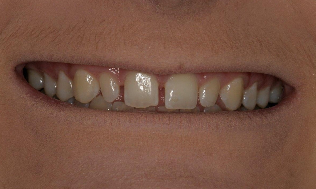 Patient before veneers | Booragoon Dentist