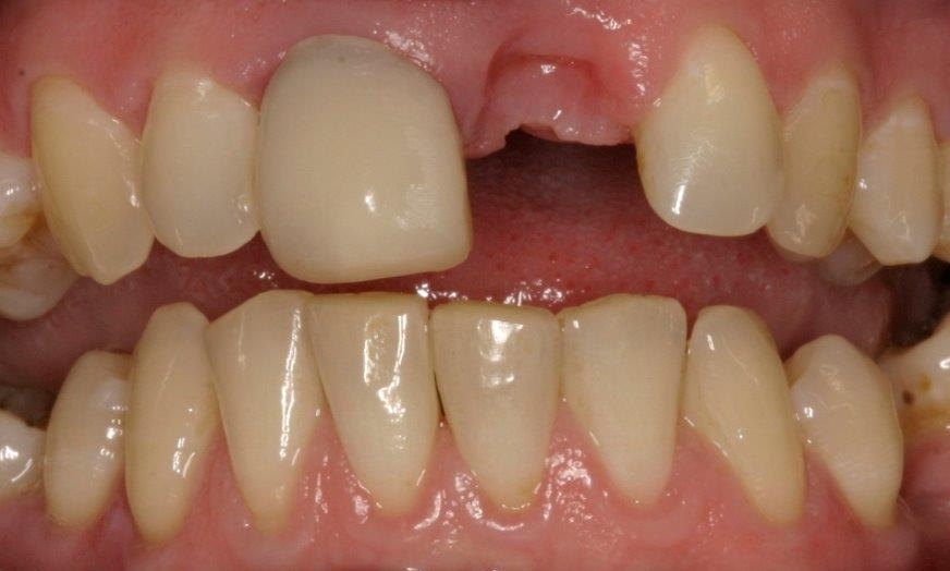 Patient with Missing Tooth | Dental Implants Booragoon