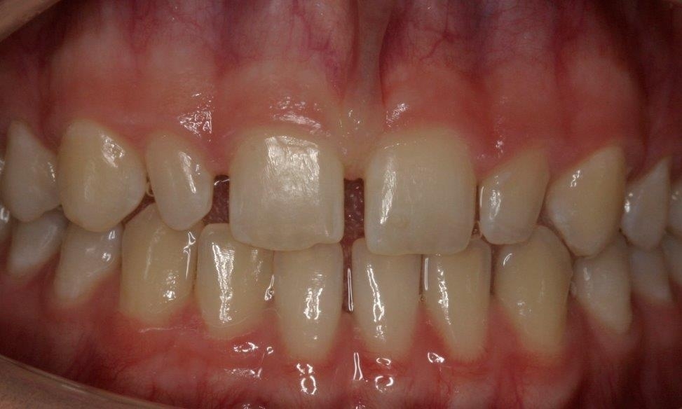 Patient before veneers | Booragoon Cosmetic Dentist