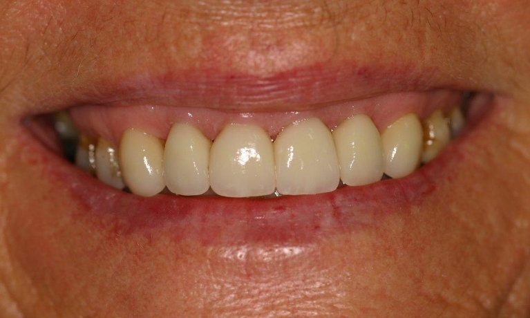 Full-Ceramic-Crowns-Near-Alfred-Cove-After-Image