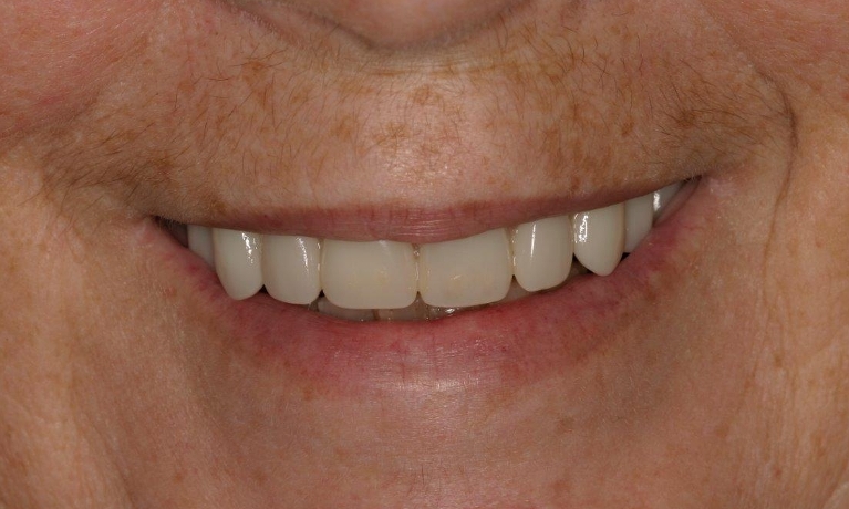 Full-Mouth-Reconstructions-with-Implants-in-Booragoon-WA-After-Image