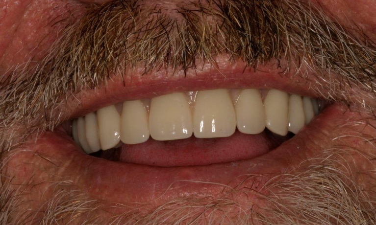 Full-Mouth-Reconstructions-with-Implants-After-Image