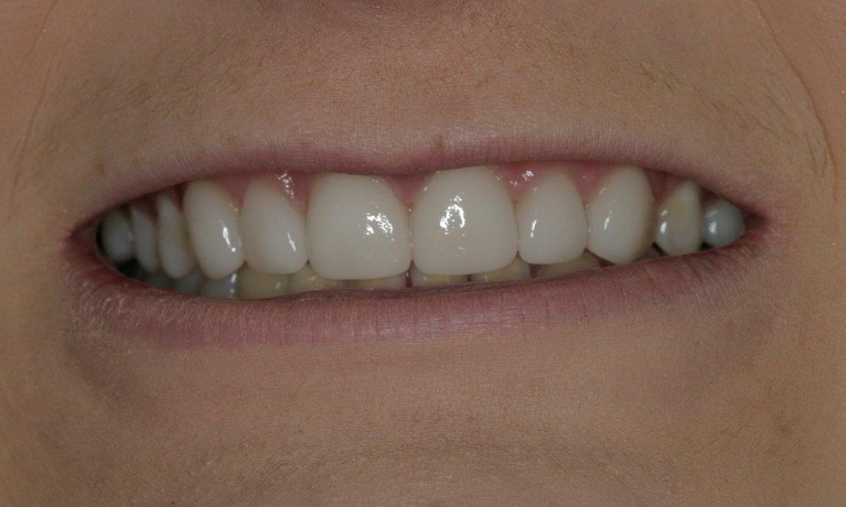 New Veneers photo | Booragoon Dentist
