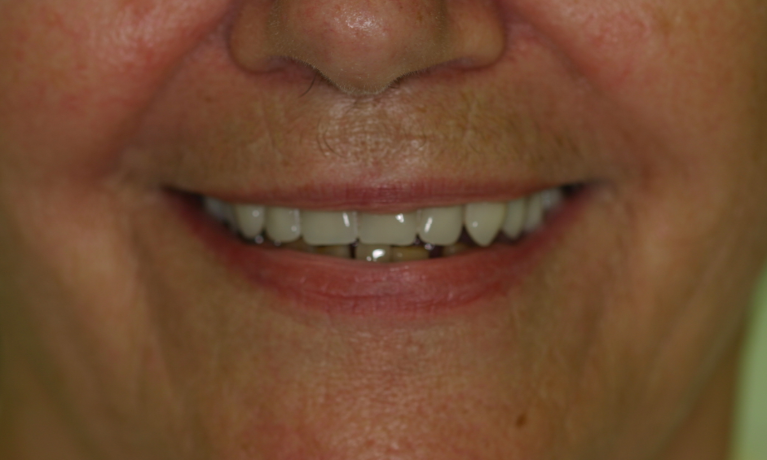 Full-Dentures-in-Booragoon-WA-After-Image